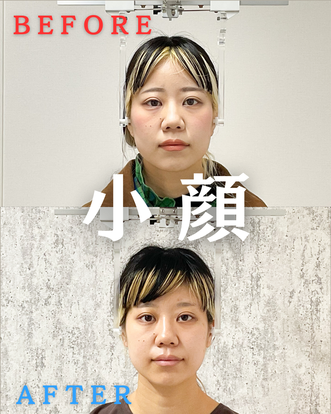 エラはり改善で小顔 施術5回目 ailes式 before・after 新宿
