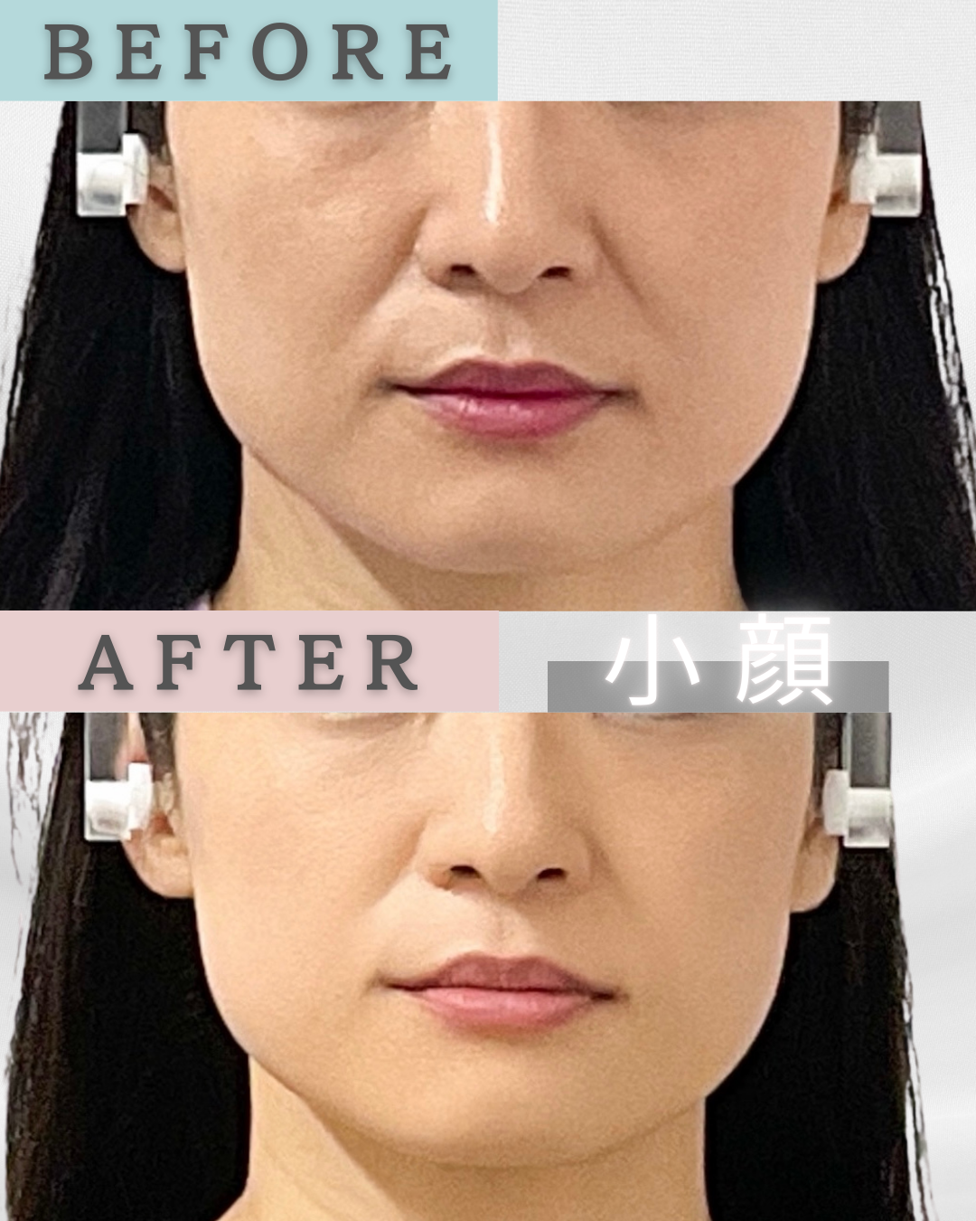 小顔 フェイスライン ailes式 before・after 新宿・食いしばり・骨盤