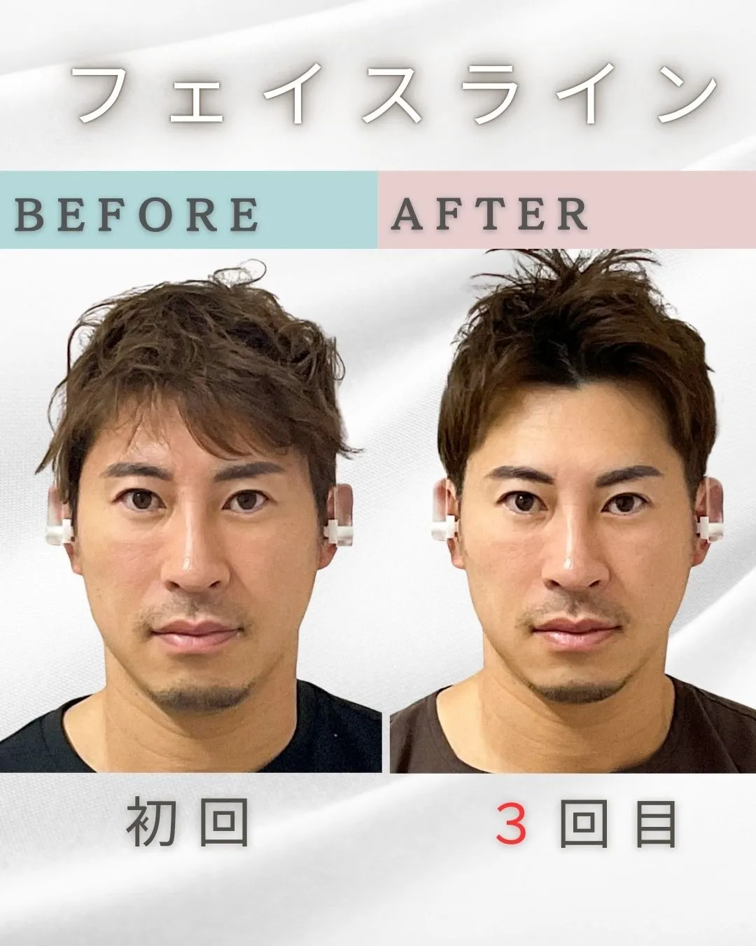 フェイスライン　施術３回目　症例写真　ailes式　before・after 新宿・食いしばり・骨盤矯正・小顔矯正・顎関節症・顔の左右差ならailesシンメトリー矯正院