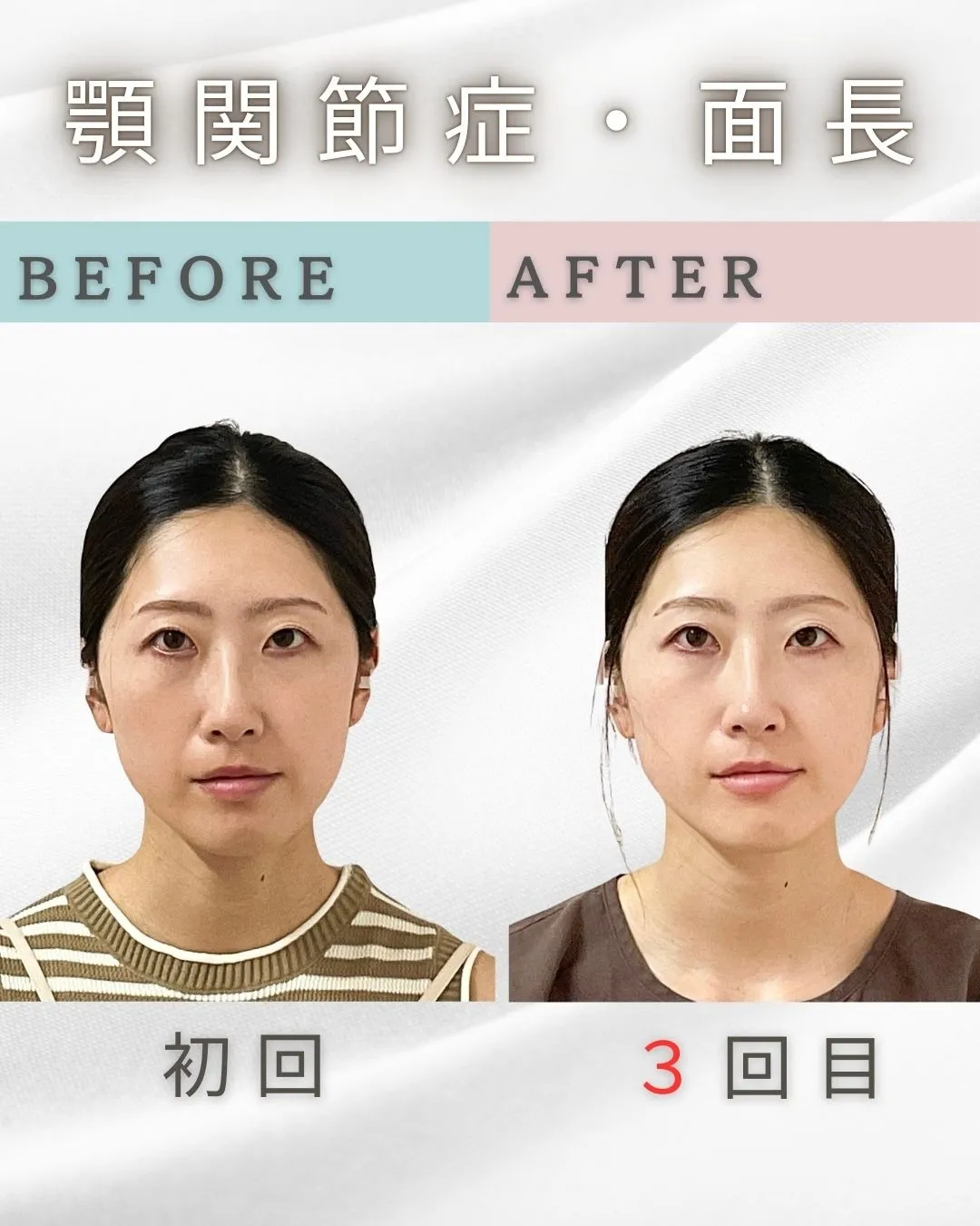 顎関節症による顔の歪みと左右差｜面長が改善した小顔矯正ビフォーアフター【3回の変化】　 新宿・代々木・食いしばり・小顔矯正・顎関節症・顔の左右差ならailesシンメトリー矯正院
