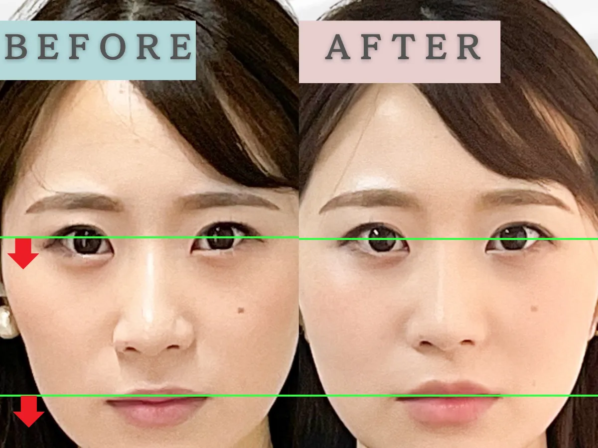  【新宿　小顔矯正】口角の左右差の変化 5回目ビフォーアフターailes式　before・after 新宿・食いしばり・骨盤矯正・小顔矯正・顎関節症・顔の左右差ならailesシンメトリー矯正院