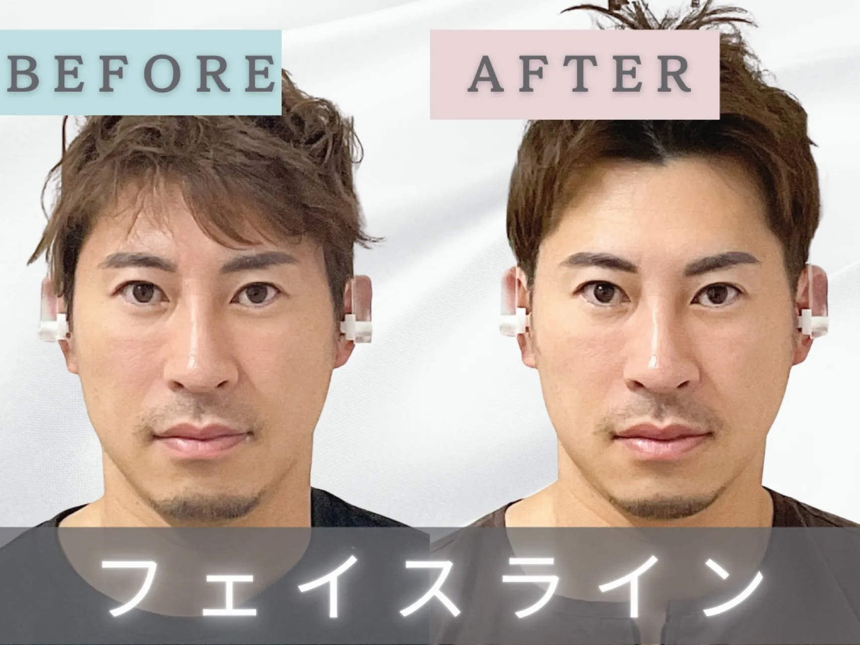 【新宿・代々木】男性のお客様｜フェイスラインが気になる方！小顔矯正6回目・10回目の経過ビフォーアフター