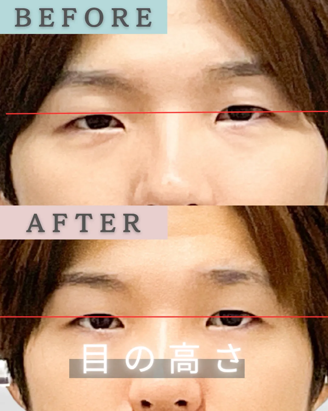 顔の歪みと左右差｜カラダからバランスの整った小顔矯正ビフォーアフター【10回の変化】　 新宿・代々木・食いしばり・小顔矯正・顎関節症・顔の左右差ならailesシンメトリー矯正院