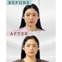 【新宿・小顔】5回目の施術で見えてくる変化｜筋肉とバランスからのアプローチailes式 新宿・食いしばり・骨盤矯正・小顔矯正・顎関節症・顔の左右差ならailesシンメトリー矯正院